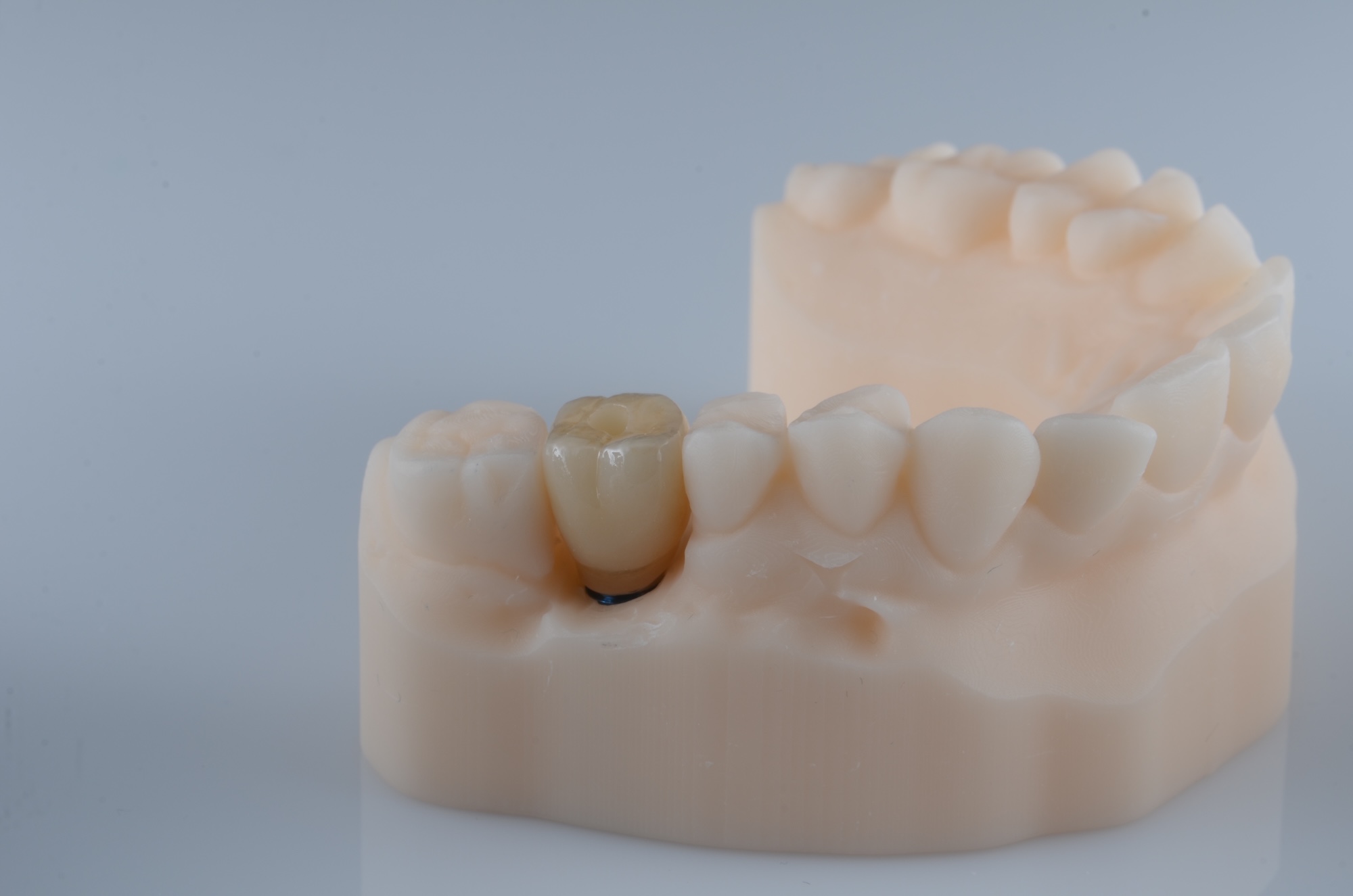 Zirconia Implant Crown on Customised Abutment